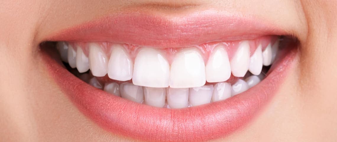 The same patient’s upper teeth after whitening treatment at Kayan