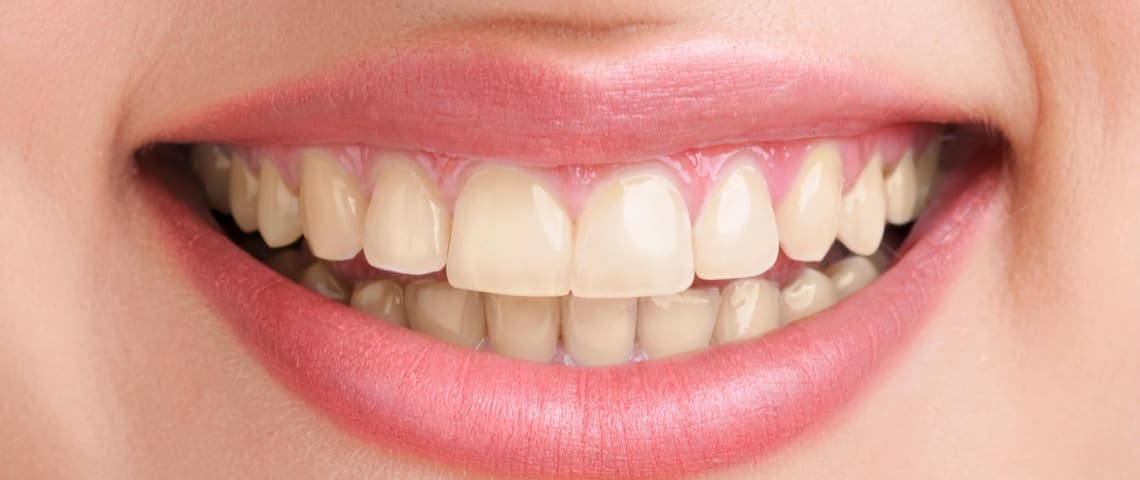 A patient’s upper teeth before whitening treatment at Kayan