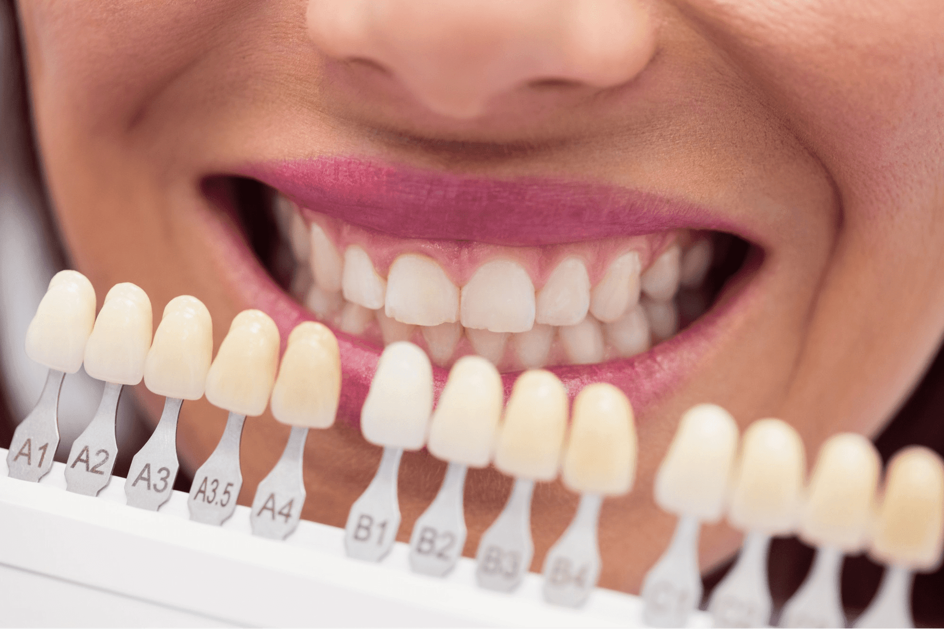 Veneers being matched for shade at Kayan Dental Clinics