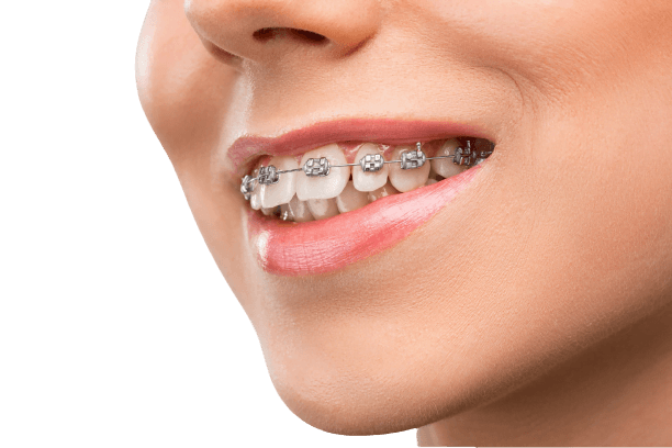 Clear aligners at Kayan Dental Clinics
