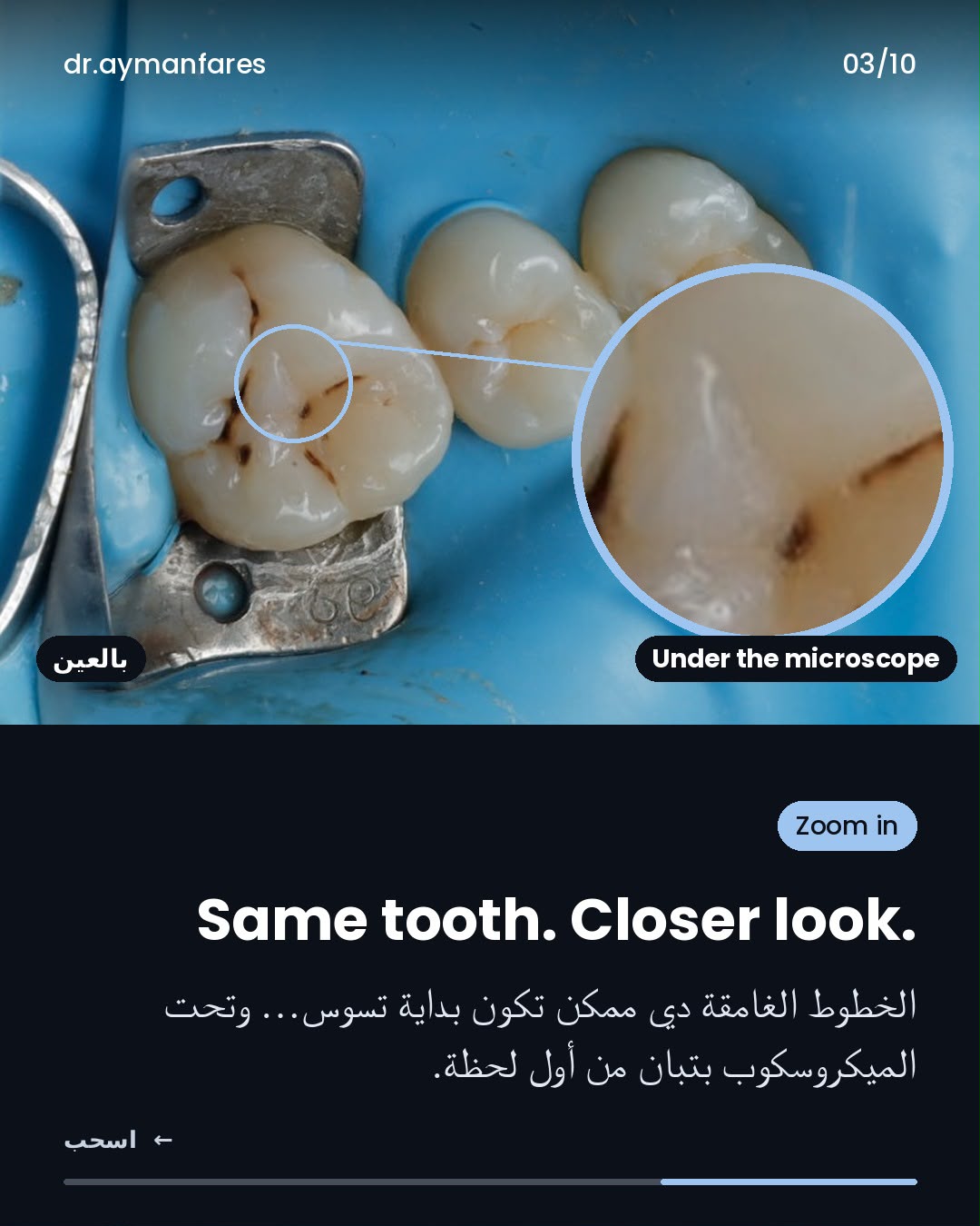 نفس السنة بنظرة أقرب — الخطوط الغامضة اللي ممكن تكون بداية تسوس بتظهر تحت الميكروسكوب